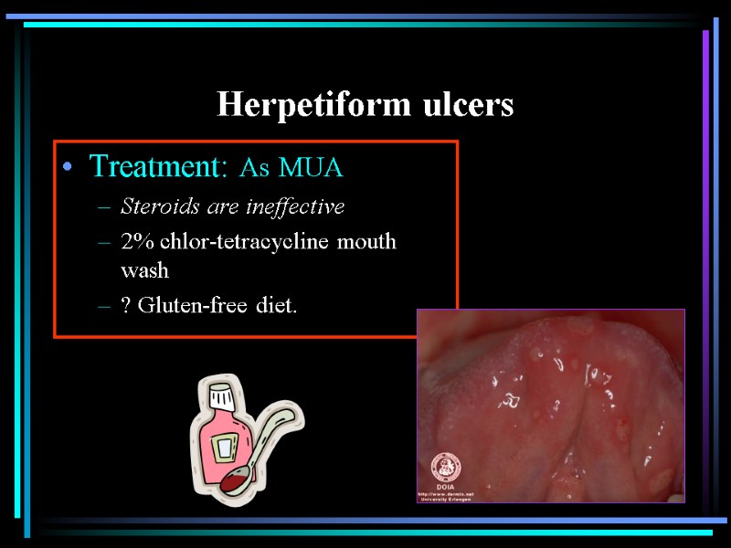 Herpetiform ulcers Treatment: As MUA Steroids are ineffective 2% chlor-tetracycline mouth wash ? Gluten-free